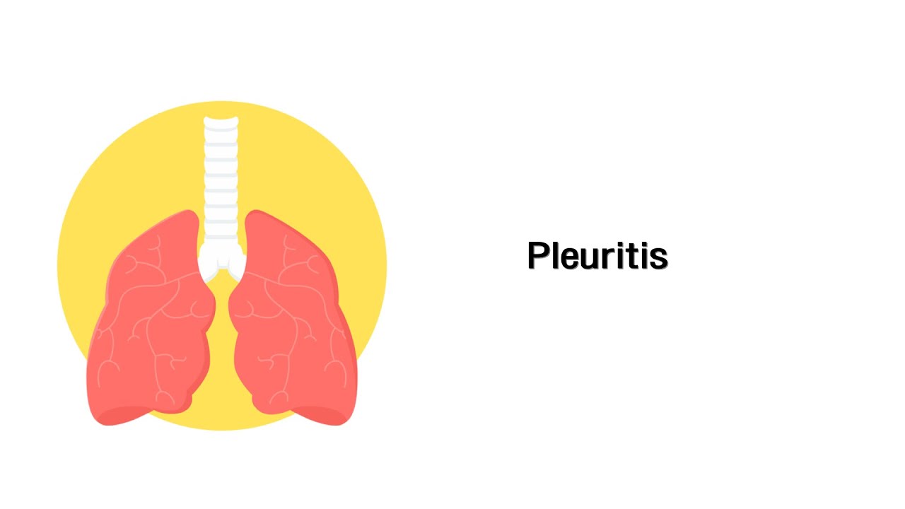 Rippenfellentzündung: Symptome, Ursachen Und Behandlung Von Pleuritis